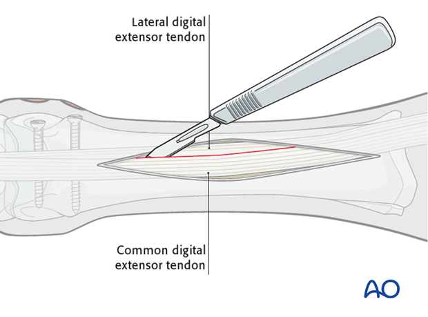 Dorsolateral approach for medial condylar fractures