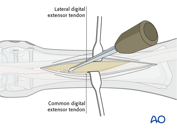 Plate fixation for Medial condyle incomplete fractures