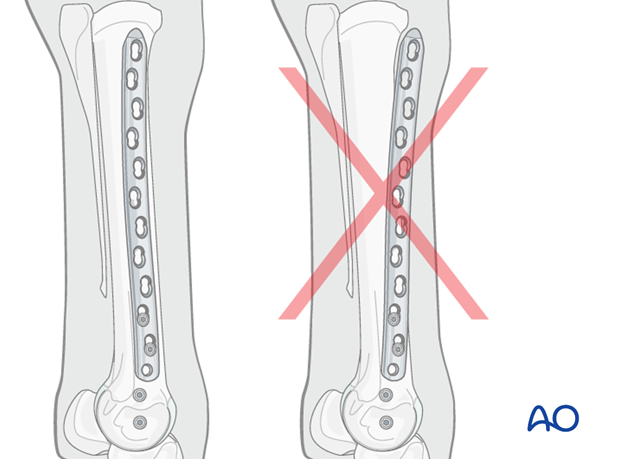 Medial incomplete condylar fracture - plate fixation