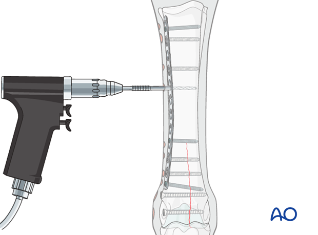 Medial incomplete condylar fracture - plate fixation