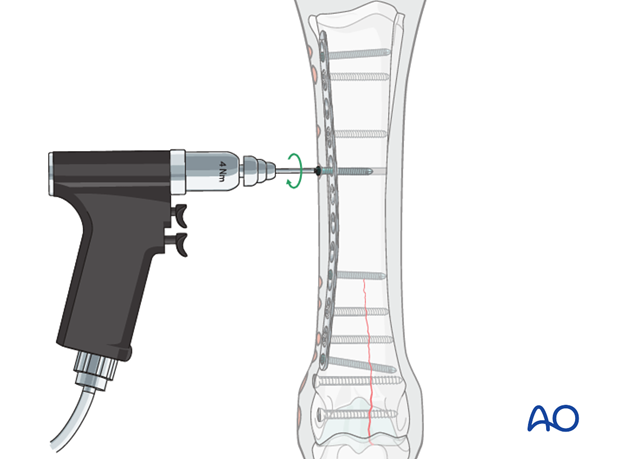 Medial incomplete condylar fracture - plate fixation