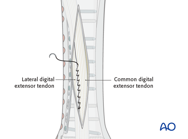 dorsolateral approach for medial condylar fractures