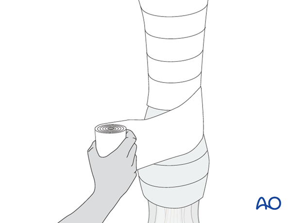 dorsolateral approach for medial condylar fractures