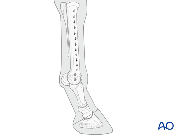 Medial incomplete condylar fracture - plate fixation