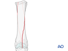 medial condyle spiral fractures