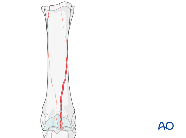 Medial spiral condylar fracture
