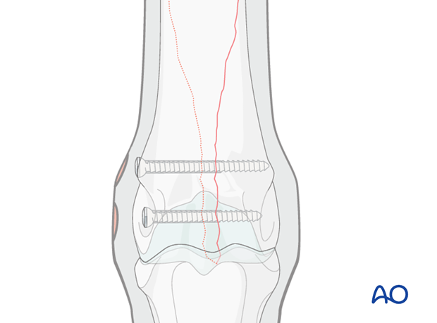 Medial spiral condylar fracture - screw fixation