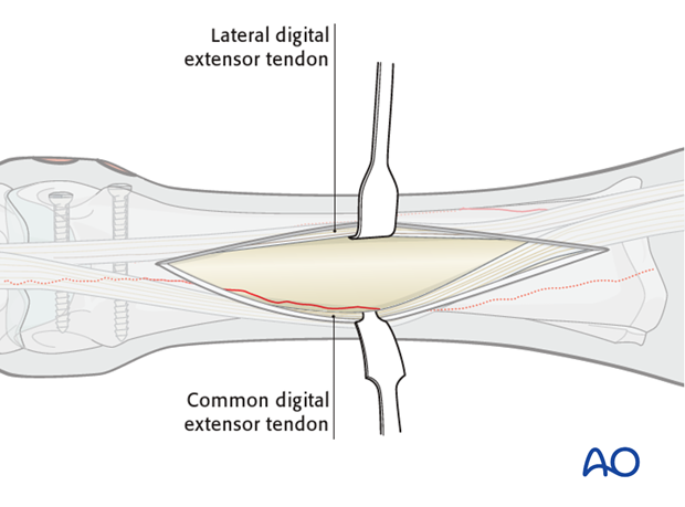 Medial spiral condylar fracture - screw fixation