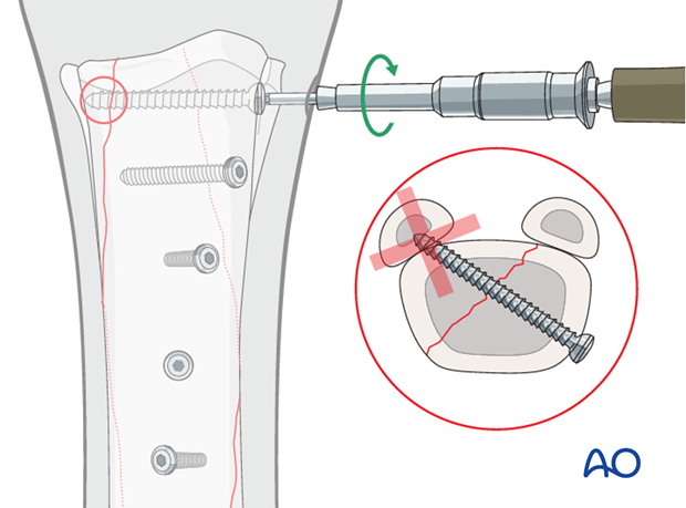 Medial spiral condylar fracture - screw fixation