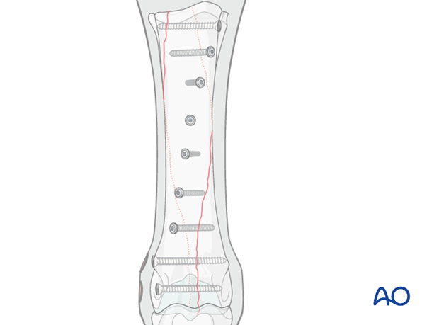 Medial spiral condylar fracture - screw fixation