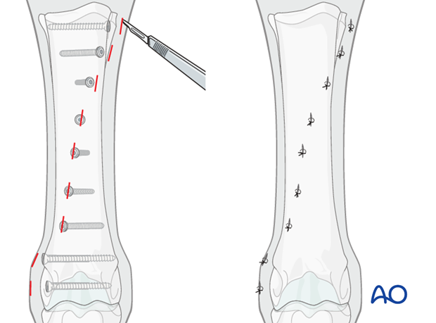 Medial spiral condylar fracture - screw fixation