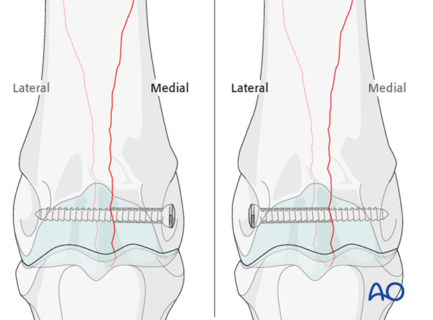 Medial spiral condylar fracture - screw fixation