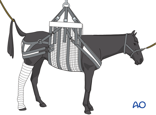 Medial spiral condylar fracture - screw fixation