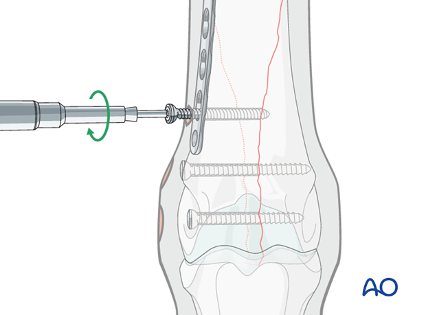 Medial spiral condylar fracture - plate fixation