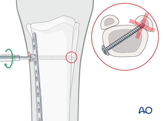 Medial spiral condylar fracture - plate fixation