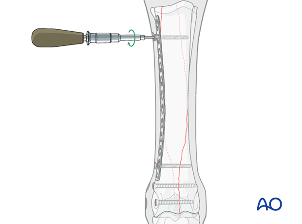 Medial spiral condylar fracture - plate fixation