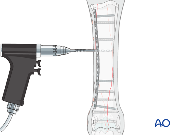Medial spiral condylar fracture - plate fixation