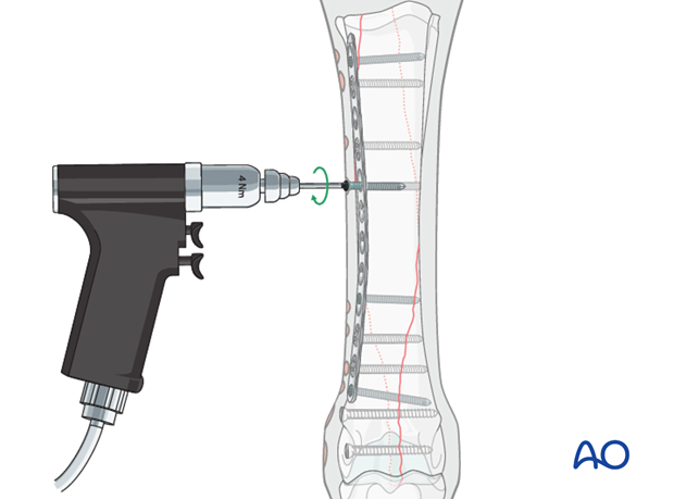 Medial spiral condylar fracture - plate fixation