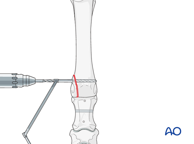 arthrodesis tension bad using wires or the sesamoid bones