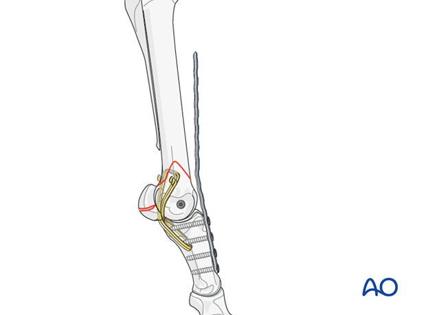 arthrodesis tension bad using wires or the sesamoid bones