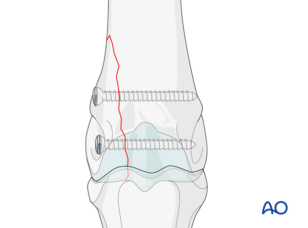 H87_C10_i300 Screw fixation