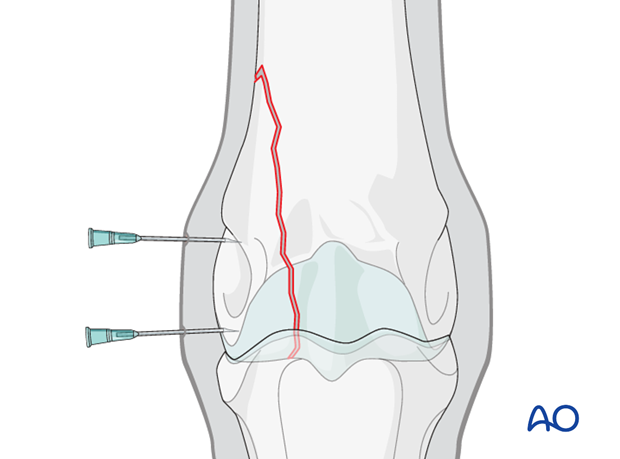 H87_C10_i320 Insert needles