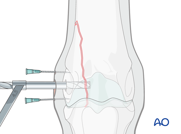 H87_C10_i340 Drill glide hole