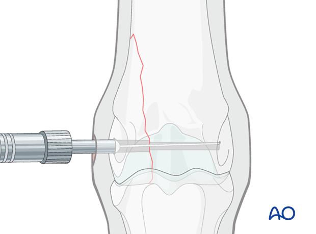 H87_C10_i370 Determine screw length