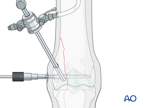 H87_C10_i380 Insert arthroscope