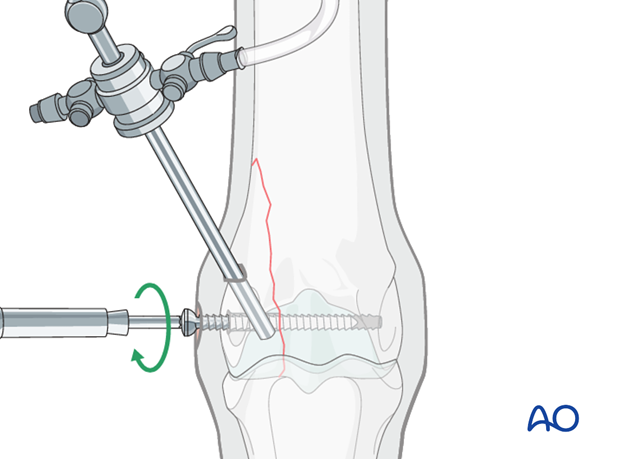 H87_C10_i385 Insert screw