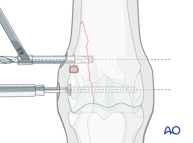 H87_C10_i400 Screw driver while drilling for additional screws