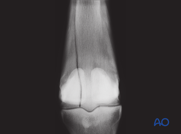 H87_C10_x100 Complete lateral condylar fracture