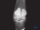Nonsurgical treatment is an option for short (< 2 cm) fractures in racehorses but is not preferred
