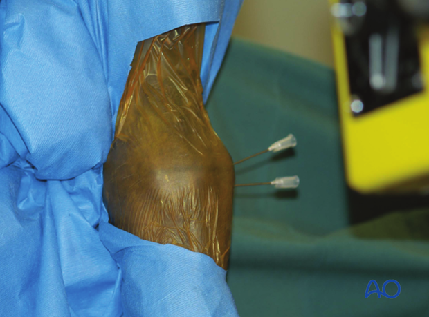 H87_C10_x130 In this clinical photograph, two needles have been used as this facilitates making the stab incision in the most appropriate spa