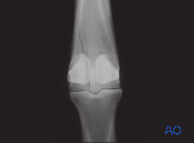 H87_C10_x160 Case: 3-year old Thoroughbred colt with lateral incomplete nondisplaced fracture