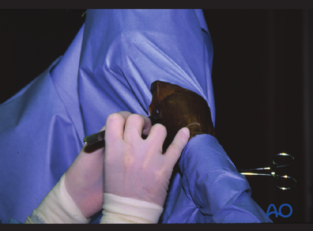 H87_C10_x170 The stab incision is performed over the lateral codylar fossa.