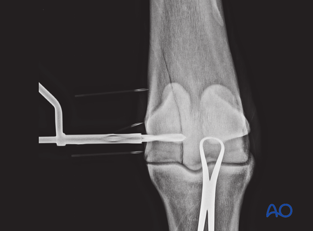 H87_C10_x200 Dorsopalmar radiograph