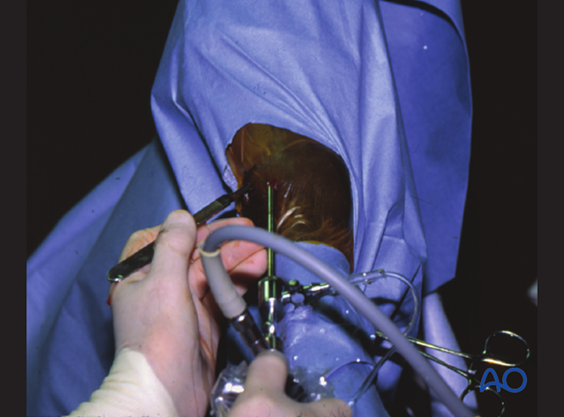H87_C10_x220 Insert arthroscope