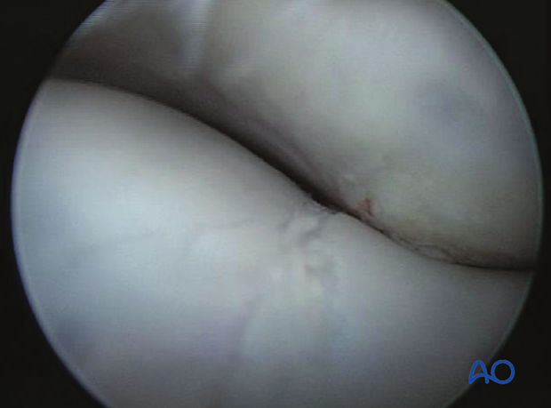 H87_C10_x240 Arthroscopic view of fracture in lateral condyle prior to compression.
