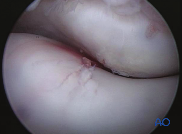 H87_C10_x250 Arthroscopic view of fracture in lateral condyle as fracture is tightened.