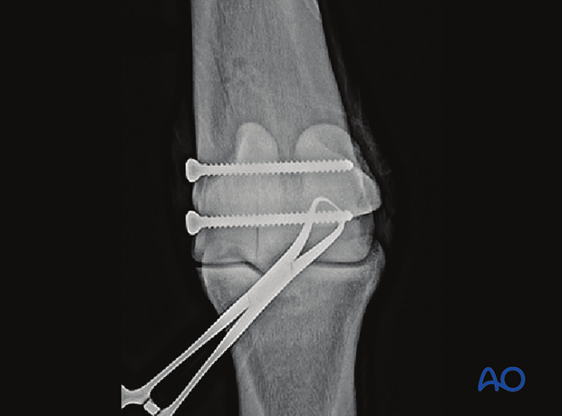 H87_C10_x270 Intraoperative dorsopalmar radiograph after both screws have been inserted and tightened.