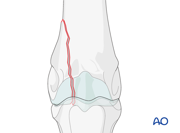 Displaced lateral condylar fracture