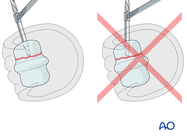 Displaced lateral condylar fracture - screw fixation