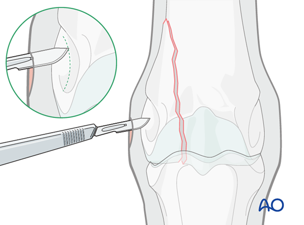 Displaced lateral condylar fracture - screw fixation