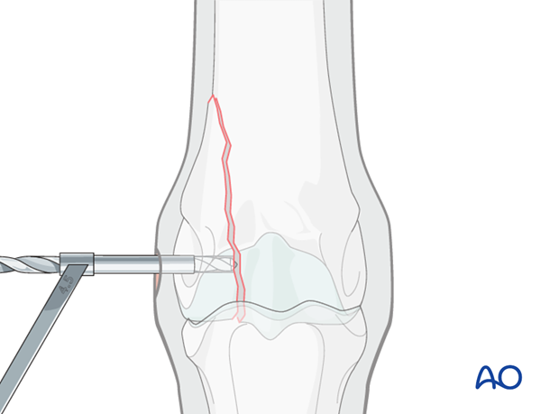 Displaced lateral condylar fracture - screw fixation