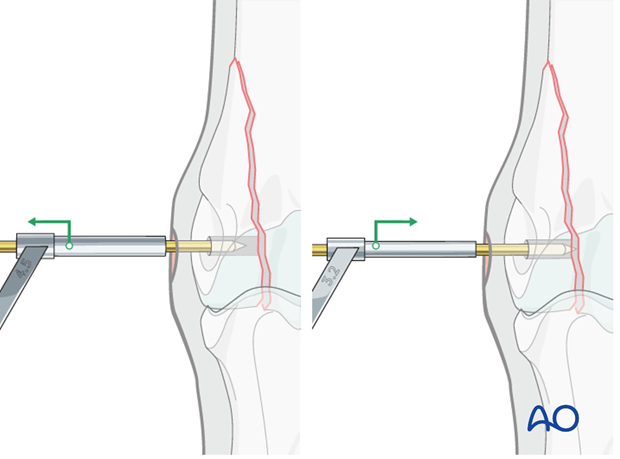 Displaced lateral condylar fracture - screw fixation