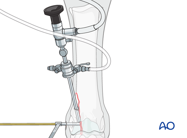 Displaced lateral condylar fracture - screw fixation