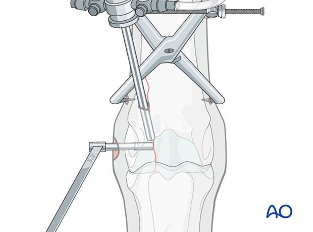 Displaced lateral condylar fracture - screw fixation