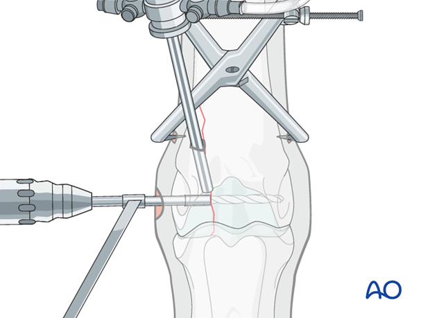 Displaced lateral condylar fracture - screw fixation