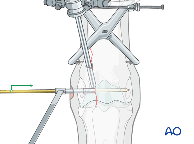 Displaced lateral condylar fracture - screw fixation